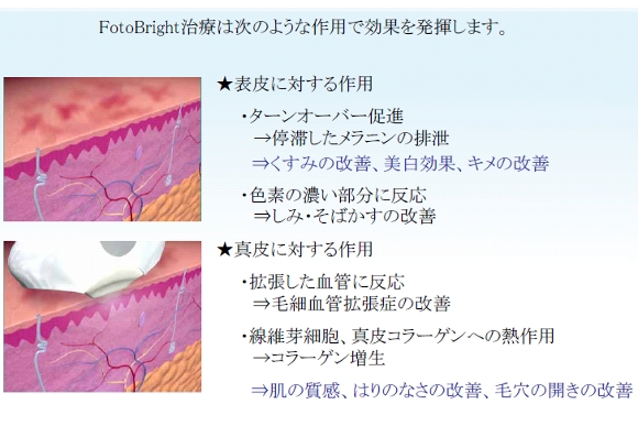 美白の為の最新光治療器