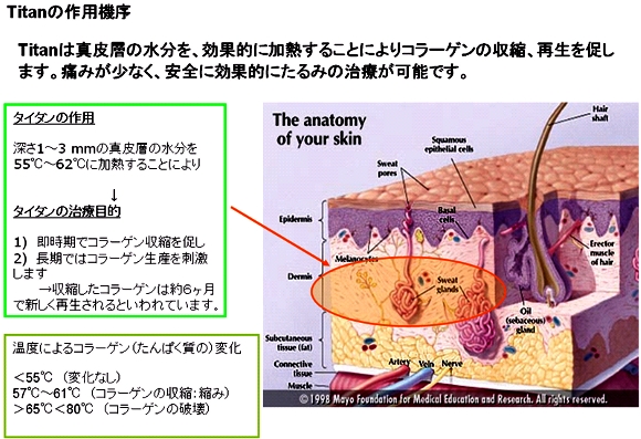 切らないたるみ治療 タイタン